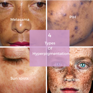 how to treat your hyperpigmentation